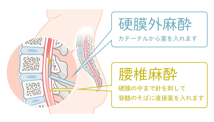 硬膜外麻酔の説明イラスト